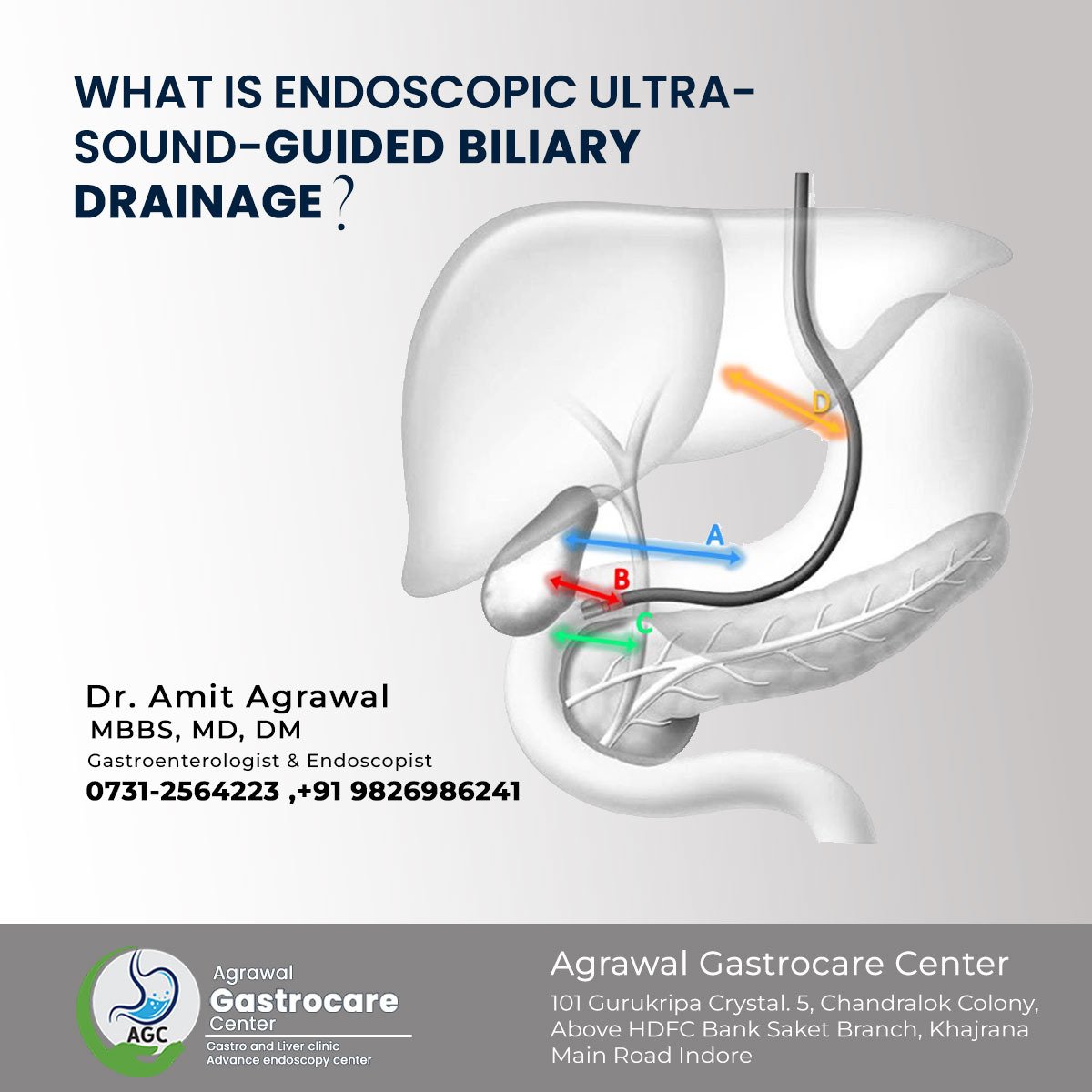 What Is Endoscopic Ultrasound Guided Biliary Drainage Agrawal