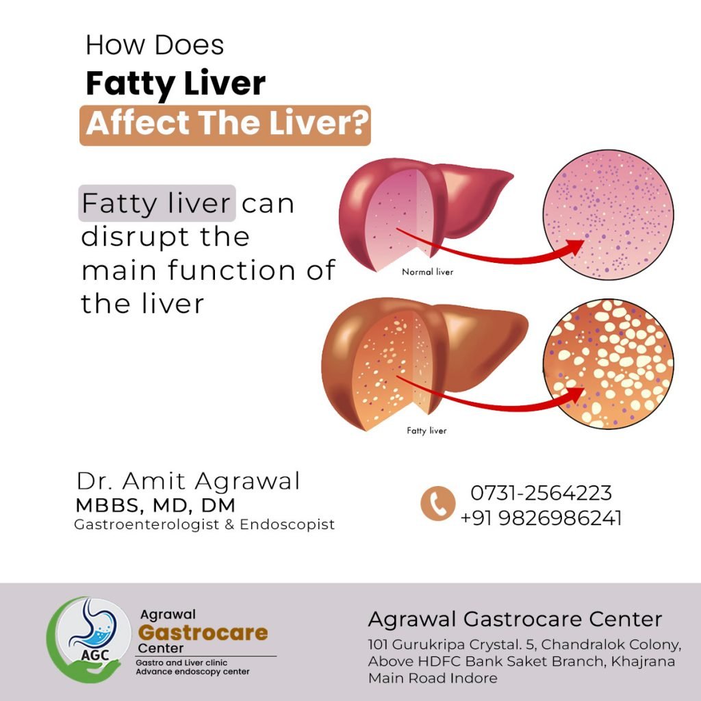 How Does Fatty Liver Affect The Liver?, Diagnosis - Dr. Amit Agrawal