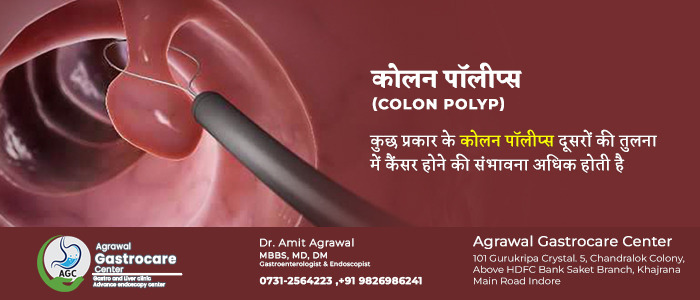 कोलन पॉलीप, कारण, लक्षण, इलाज | Colon Polyp in Hindi