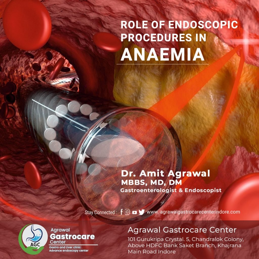 Role of Endoscopic Procedures in Anaemia - Agrawal Gastrocare Center Indore