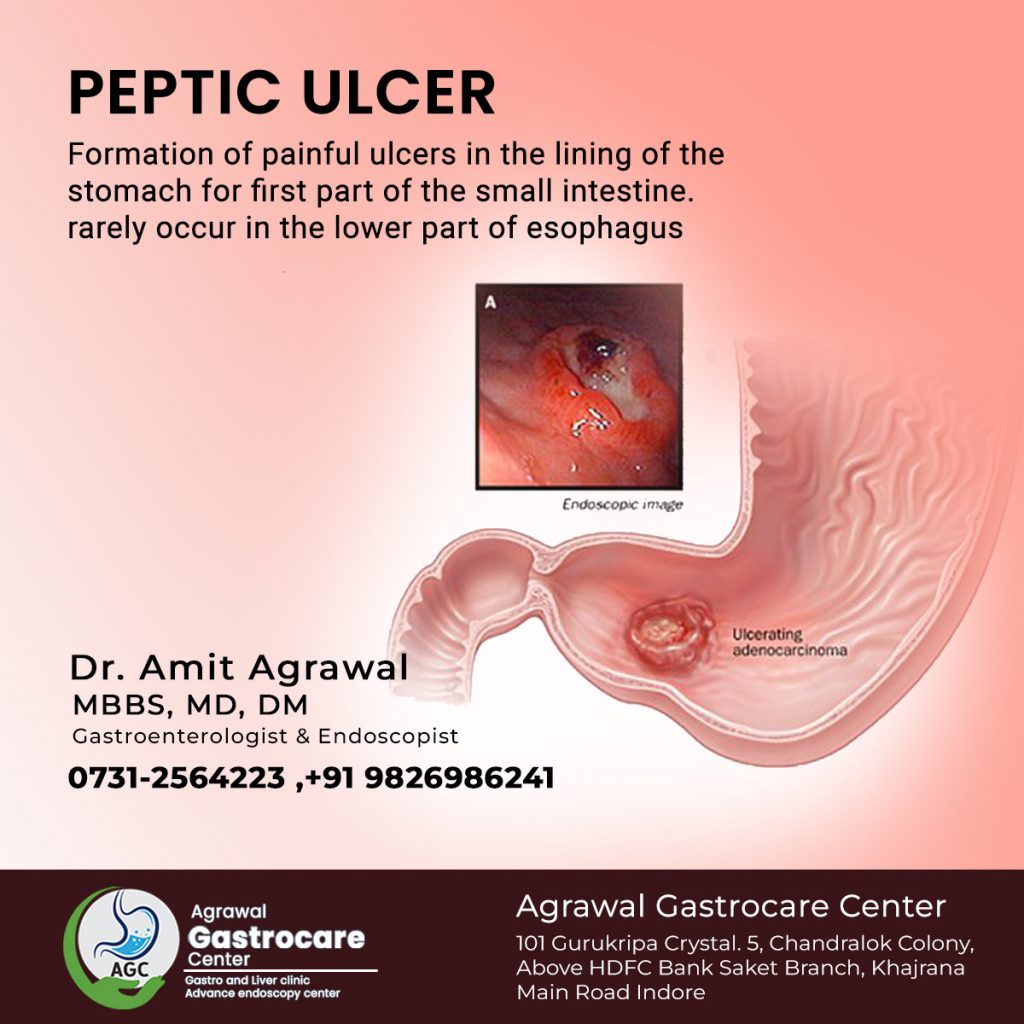What is Peptic Ulcer, Treatment - Agrawal Gastrocare Center Indore