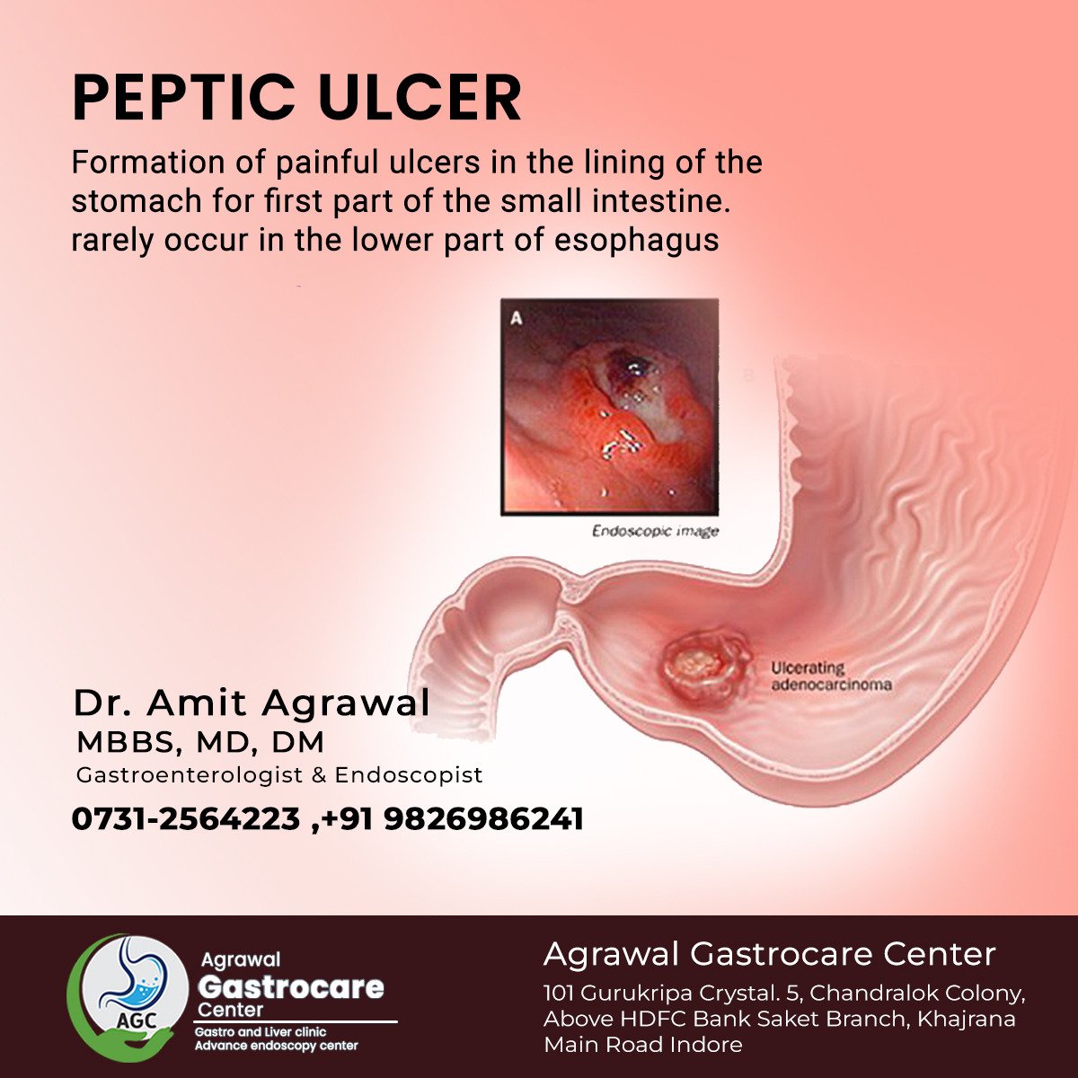 What Is Peptic Ulcer Treatment Agrawal Gastrocare Center Indore