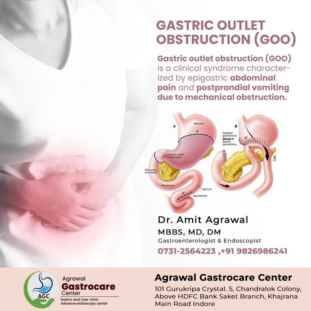 Gastric Outlet Obstruction, Causes, Symptoms, Treatment - Agrawal Gastrocare Center Indore
