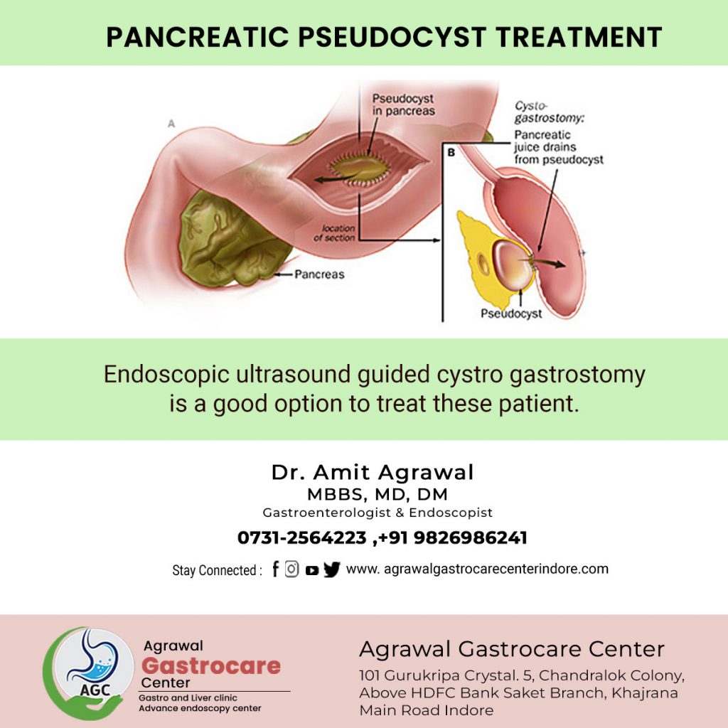 Pancreatic Pseudocyst Treatment, Causes, Symptoms - Agrawal Gastrocare Center Indore