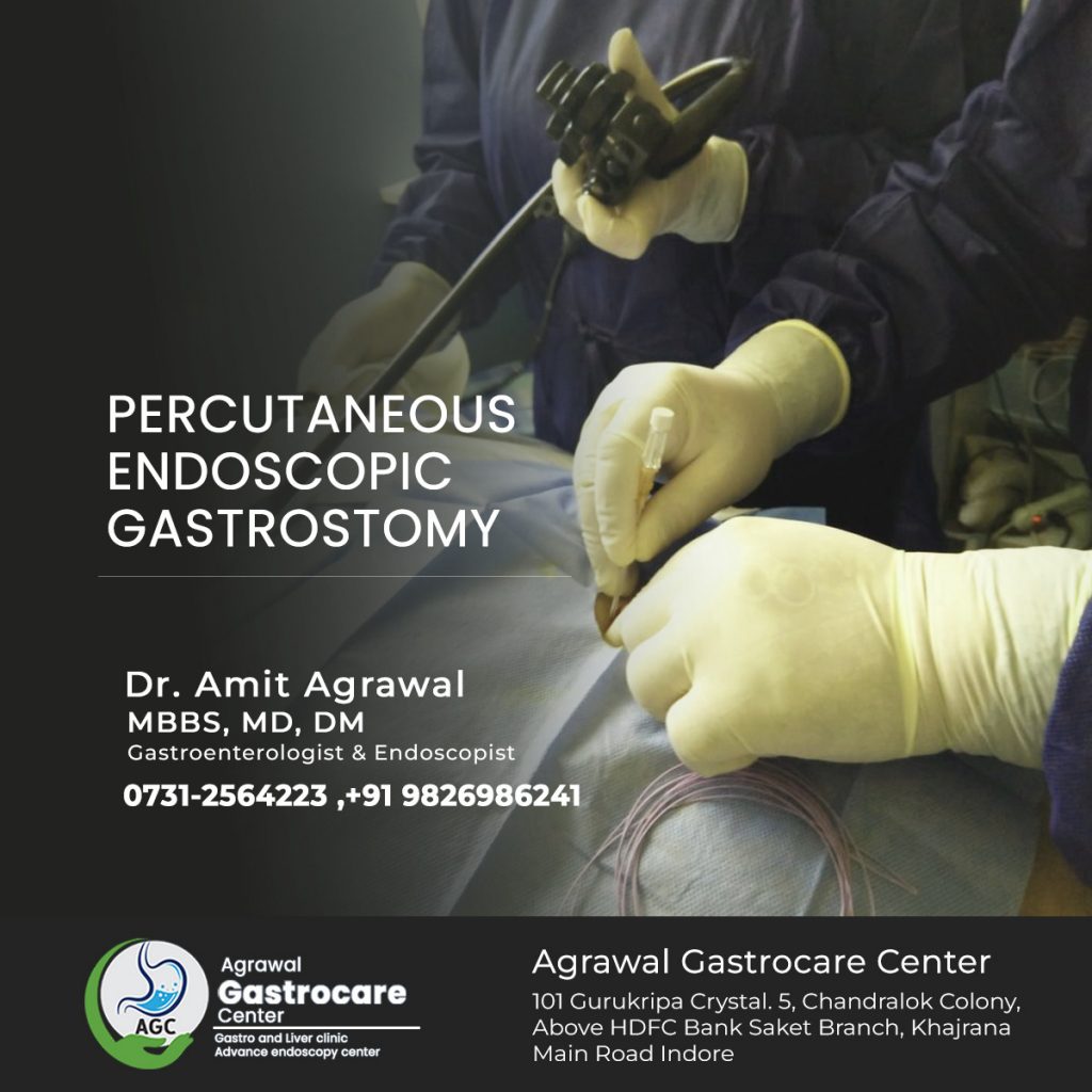 Percutaneous Endoscopic Gastrostomy, Used, Risks - Agrawal Gastrocare Center Indore