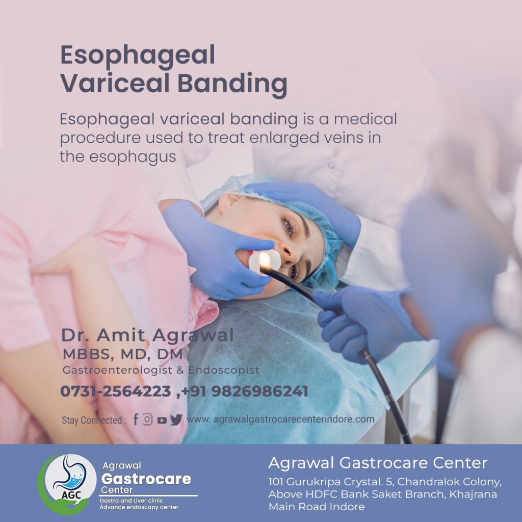 Esophageal Variceal Banding, Procedure, Risk, Need - Agrawal Gastrocare Center Indore
