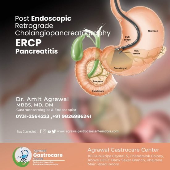 Post Endoscopic Retrograde Cholangiopancreatography (ERCP) Pancreatitis ...