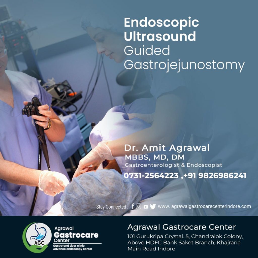 Endoscopic Ultrasound-Guided Gastrojejunostomy - Agrawal Gastrocare Center Indore