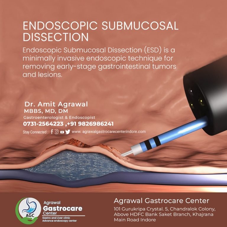 Endoscopic Submucosal Dissection, Procedure, Performance, Post ...