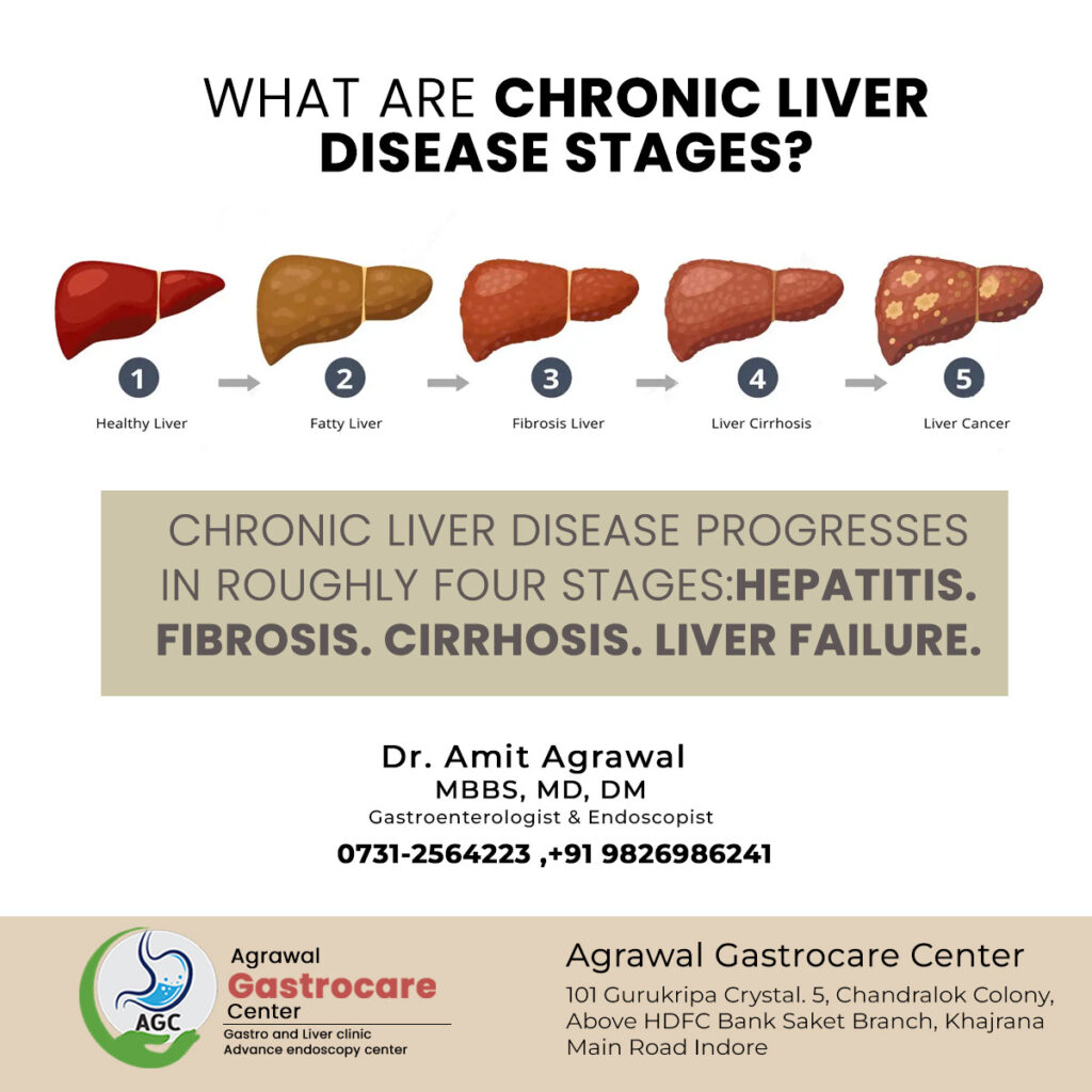 What are Chronic Liver Disease Stages?