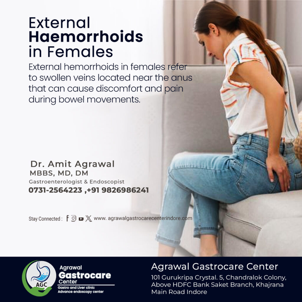 External Hemorrhoids in Females, Symptoms, Diagnosis, Treatment & More