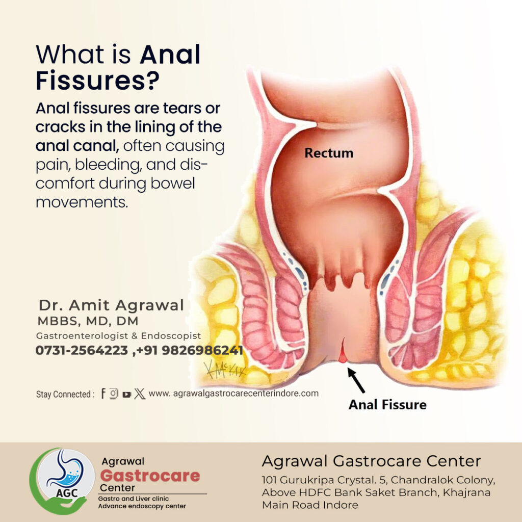 What is Anal Fissures?, Symptoms, Causes, Treatment
