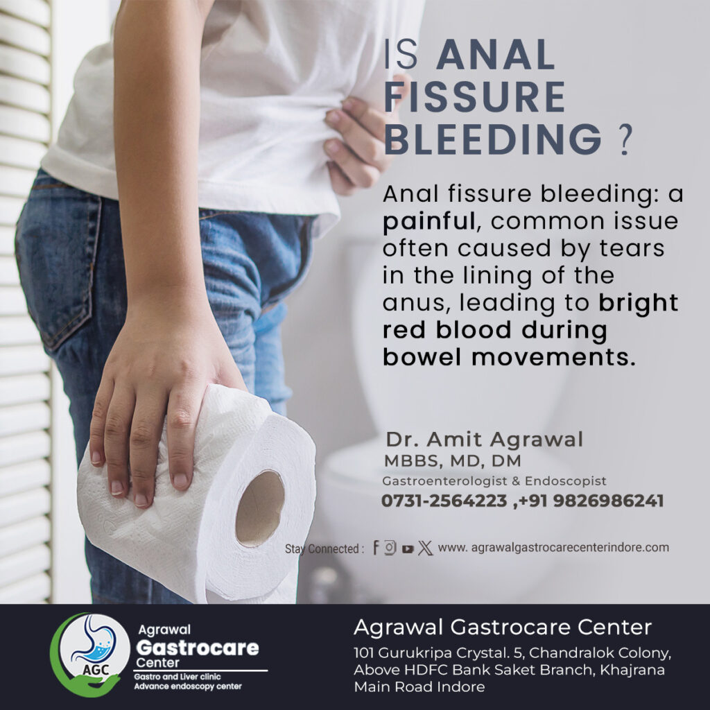 Anal Fissure Bleeding - Agrawal Gastrocare Center 
